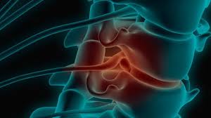 terapi syaraf kejepit berpengalaman   Semarang Barat